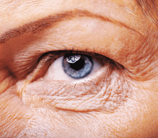 Blepharoplasty